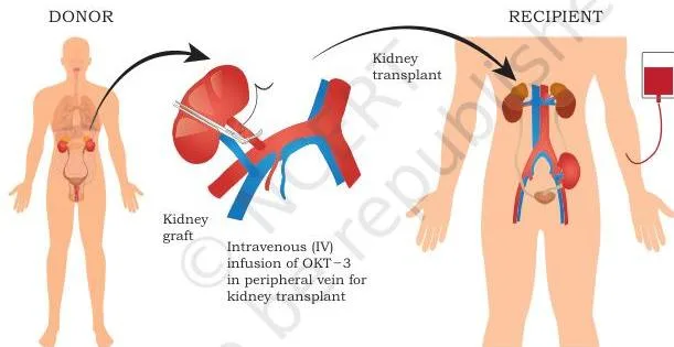 Use of OKT-3 during kidney transplantation: a monoclonal antibody binds CD3 on T cells, blocking the T cells that cause acute graft rejection