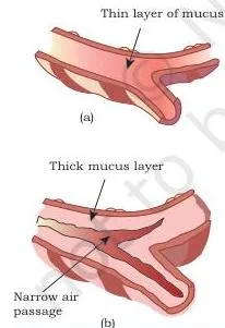 Applications of Recombinant DNA Technology Class 12 PDF Two cross-sections of an air passage, the first open and clear, the second narrowed and clogged by mucus in cystic fibrosis