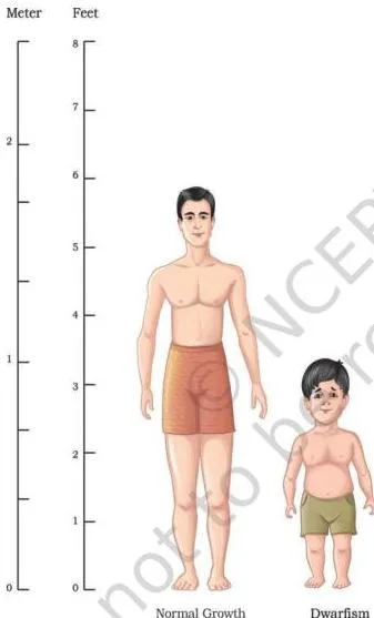 Applications of Recombinant DNA Technology Class 12 PDF Two photographs contrasting a child of typical stature with a child showing the retarded growth and unusual body proportions caused by human growth hormone deficiency
