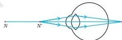 Ray diagram of a hypermetropic eye where light rays from a close object converge to form an image behind the retina, causing blurred near vision