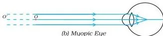 Ray diagram of a myopic eye where parallel light rays from a distant object converge to form an image in front of the retina, causing blurred distance vision