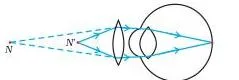 Ray diagram showing a convex lens placed in front of a hypermetropic eye, adding converging power so the image of a close object falls on the retina