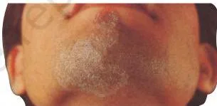 Human Health and Disease Class 12: NCERT Chapter 7 PDF A diagram of a skin area affected by ringworm showing dry scaly lesions, the main symptom of this fungal infection