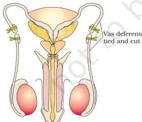 Outline of the male reproductive system marking the small section of the vas deferens that is cut or tied in vasectomy