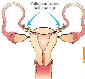Outline of the female reproductive system marking the small section of the fallopian tube that is cut or tied in tubectomy